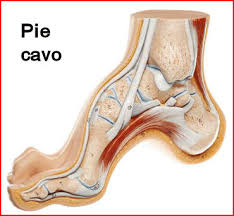 pie cavo